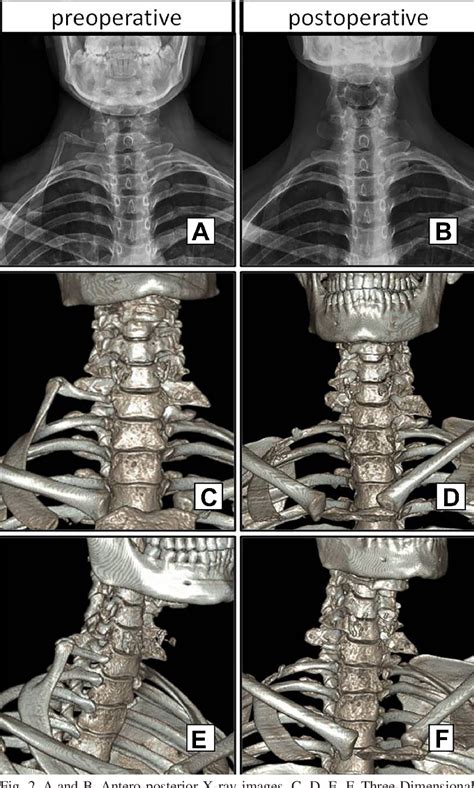Figure 2 From Cervical Rib Which Resembles Original Thoracic Rib