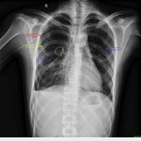 Chest X Ray Showing Resolving Pneumothorax Bilaterally Download