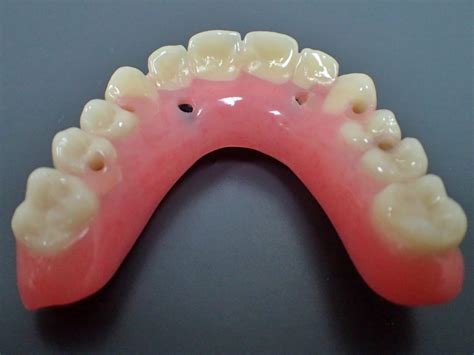 Fixed Implant Retained Hybrid Dentures Procare Denture Clinic