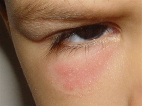 O Que E Qual A Causa Da Dermatite At Pica Prontopele