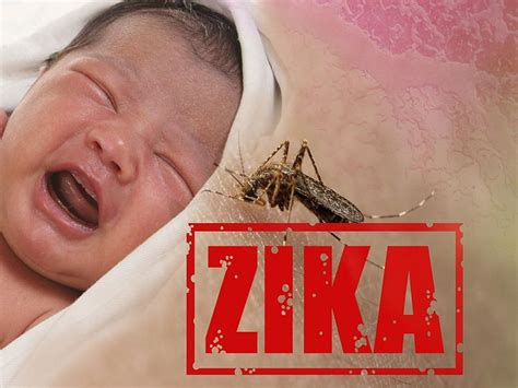 Zika Tied To Rise In Us Birth Defects Cdc