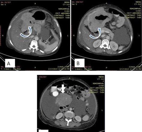 Figure 7 From Peritoneal Carcinomatosis Pictorial Review Of Computed