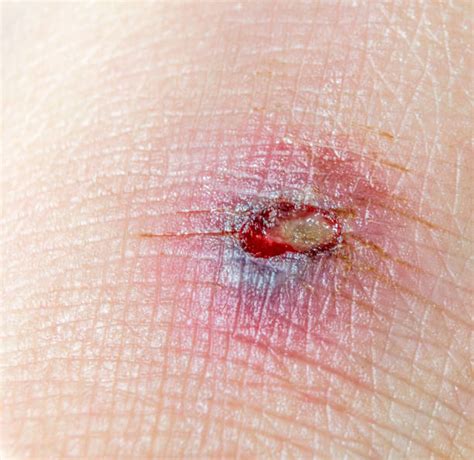Best Open Wound Healing Process Stock Photos Pictures And Royalty Free