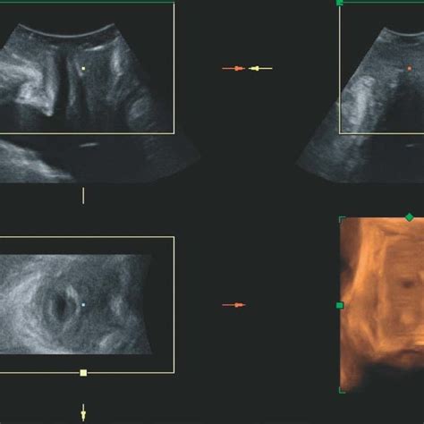 Lower Urinary Tract On Three Dimensional Transperineal Ultrasound