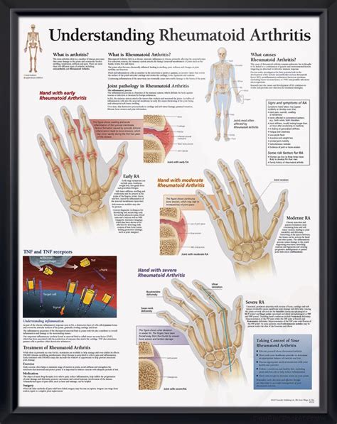 Understanding Rheumatoid Arthritis Causes Symptoms And Treatments