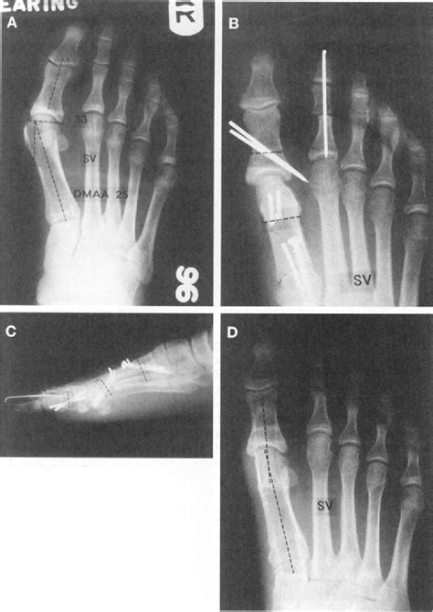 Figure 3 From Treatment Of Hallux Valgus With An Increased Distal