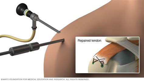 Rotator cuff injury causes tend to fall in one of two categories — an acute injury or chronic degeneration. Rotator cuff injury Disease Reference Guide - Drugs.com