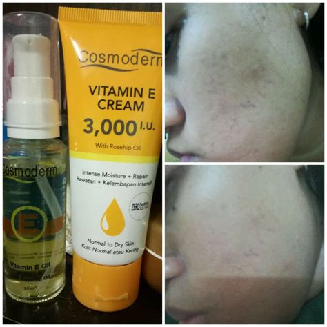 Kendati paling efektif, namun perawatan ini relatif. Cosmoderm on Twitter: "Repost from Moe Collar: Terima ...