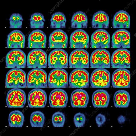 Normal Brain Activity Pet Scans Stock Image C0267613 Science