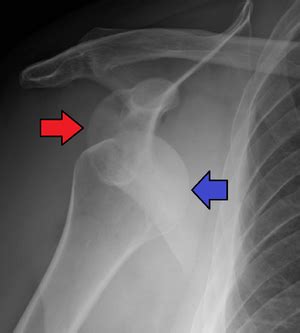 Reduction should be attempted immediately if an associated neurovascular deficit or skin tenting (due to a displaced bone fracture or, less commonly, fracture. Anterior shoulder dislocation - WikEM