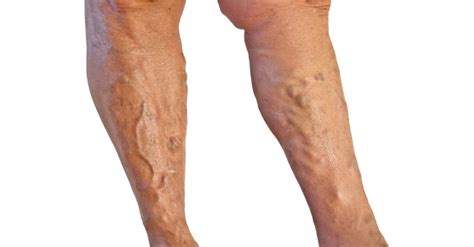 Varicose Veins Symptoms Causes Diagnosis And Treatment Options