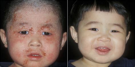 Eczema Before And After