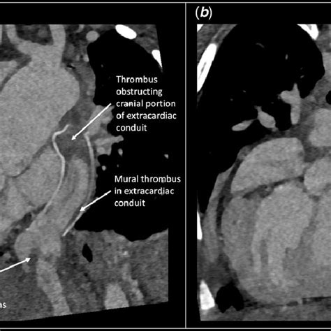 Three Dimensional Ct Angiography Reconstruction Of The Extracardiac