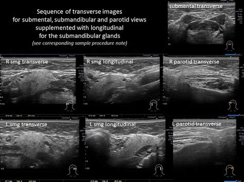 Parotid Gland Abscess Ultrasound