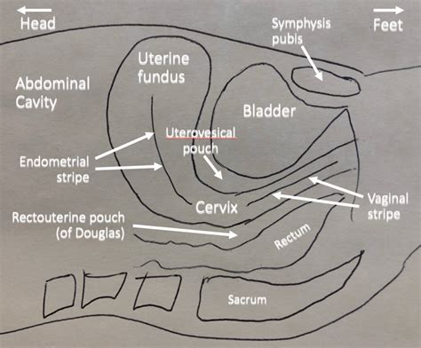 Pelvic Ultrasound Sagittal Anatomy