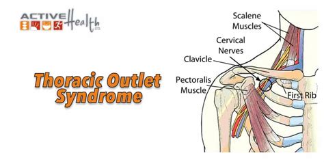 Thoracic Outlet Syndrome Chiropractor Park Ridge Il Active Health