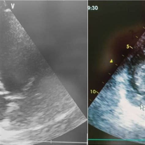 Transthoracic Echocardiography 4 Chamber View Showing A Right