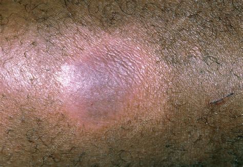 Lichen Simplex Rash On Black Skin Stock Image M2000109 Science