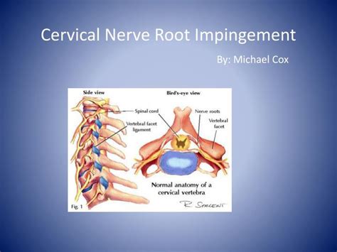 Ppt Cervical Nerve Root Impingement By Michael Cox Powerpoint