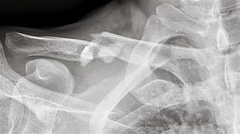 Ever wondered what a broken collarbone feels like? I did ...