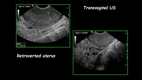 ultrasound of uterus youtube