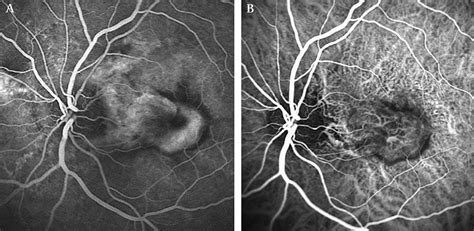 Low Fluence Rate Photodynamic Therapy Combined With Intravitreal