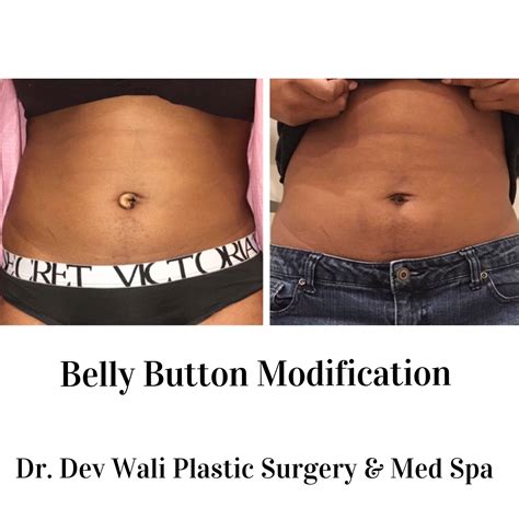 Do You Have An Outie Belly Button And Want An Innie Come See Dr Wali