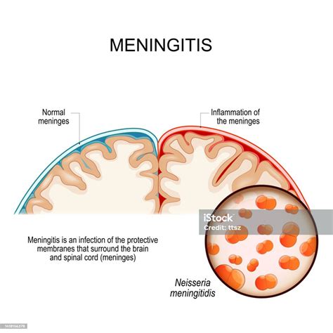 Meningitis Brain With Normal Meninges And Inflammation Of The Meninges