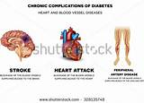 Pictures of Heart Blockage Symptoms Mayo Clinic