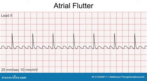 Eletrocardiograma Mostra Padrão De Flutter Auricular Ilustração Do