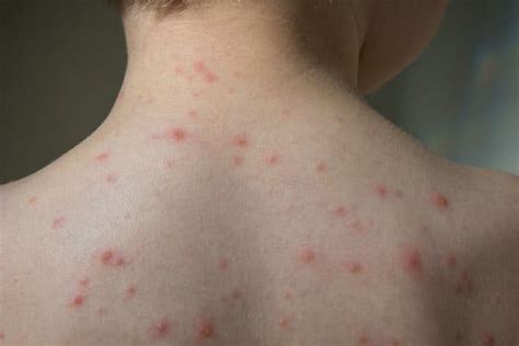 Chickenpox Outbreak Where Children Not Vaccinated Kids Care Pediatric