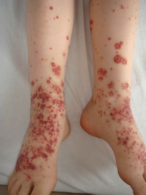 Blood disorder pigmentosa progressiva schamberg therapie. 160 Schönlein-Henoch Purpura | Plastic Surgery Key