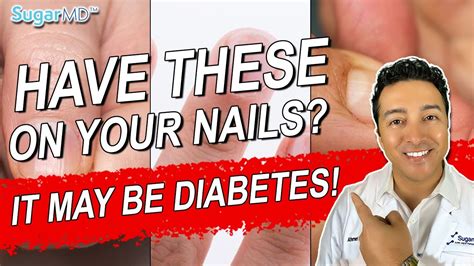 5 Diabetic Nail Problems And Top Signs Of Diabetes On The Nails Youtube