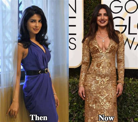 Priyanka Chopra Plastic Surgery Before And After Photos