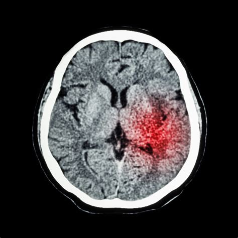 CT Scan Of Brain Show Ischemic Stroke Or Hemorrhagic Stroke NeuropointNeuropoint