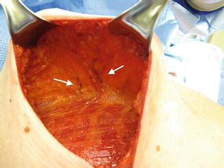 Nac necrosis occurred in none of our patients (0%). Techniques to Avoid Nipple and Flap Necrosis | Plastic ...