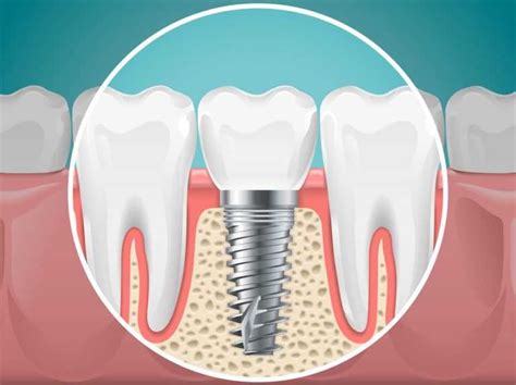 Dental Implants Meaning And Benefits Sabka Dentist Top Dental Clinic