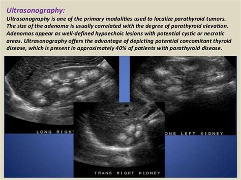 Hyperparathyroidism Ultrasound