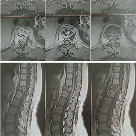 Mri Spine Sagittal And Axial View Showing Local Extension Of The Tumor