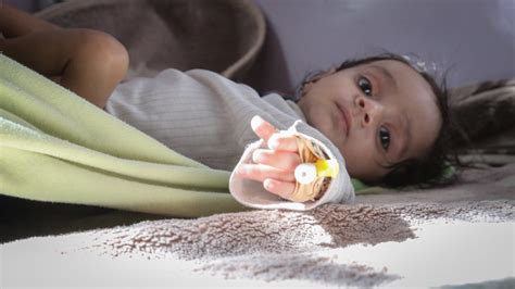 Unicef Fao Wfp Oms In Yemen La Malnutrizione Minaccia La Metà Dei
