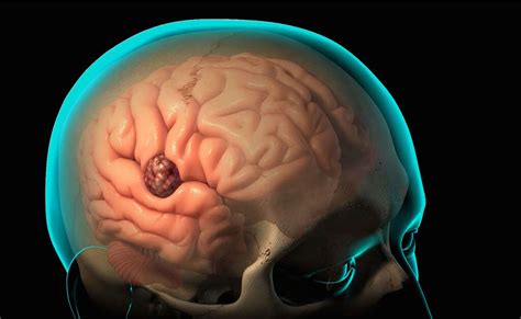 Brain Diseases 10 Common Brain Diseases