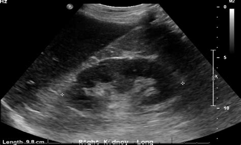Nephrostomy Tube Ultrasound