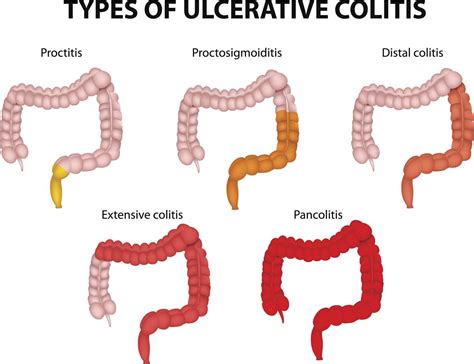 How does private health insurance cover colonoscopies? Colonoscopy Cost - Health Hearty
