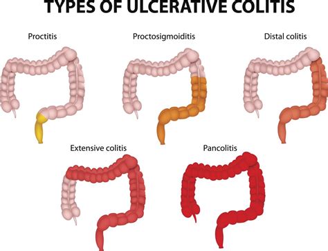 On mdsave, the cost of a colonoscopy ranges from $1,263 to $3,788. Colonoscopy Cost - Health Hearty