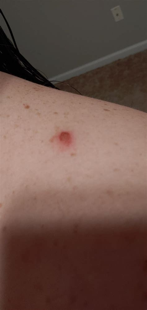 Should I Be Worried About This Sore On My Shoulder Shouldibeworried