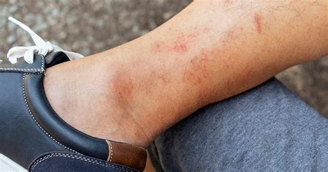 Hives Vs Rash Identification Symptoms Causes And Treatment
