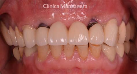 Caso clínico extracción y reposición puente dental sobre implantes