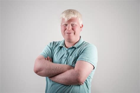 Czym Jest Albinizm Przyczyny Objawy Leczenie HelloZdrowie