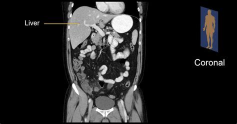 Abdominal Ct Planes Litfl Radiology Library