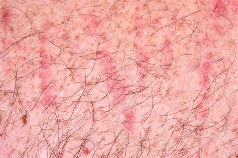 Dermatographic Vascular Urticaria Stock Image C0345317 Science